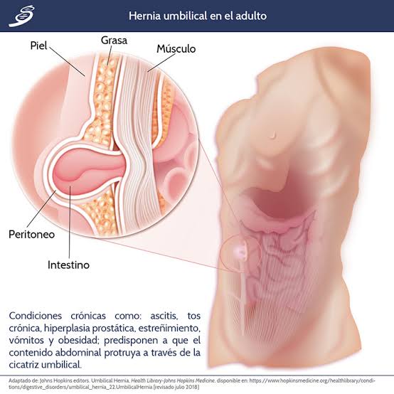 Hernia del ombligo o umbilical